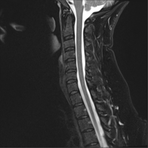 File:Normal cervical spine MRI (including Dixon) (Radiopaedia 42762-45925 Dixon- Water 8).png
