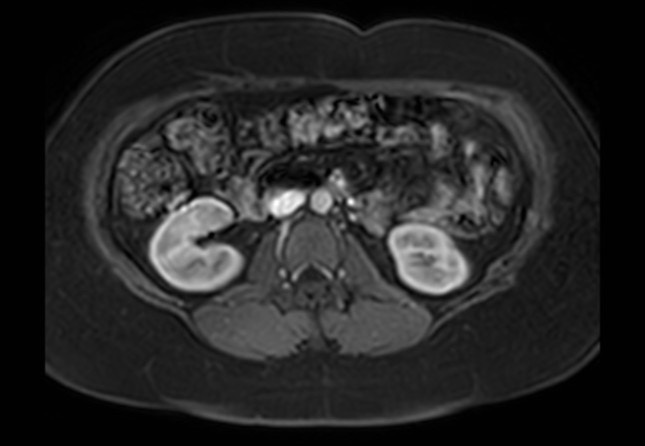 Normal liver MRI with Gadolinium (Radiopaedia 58913-66163 J 13).jpg