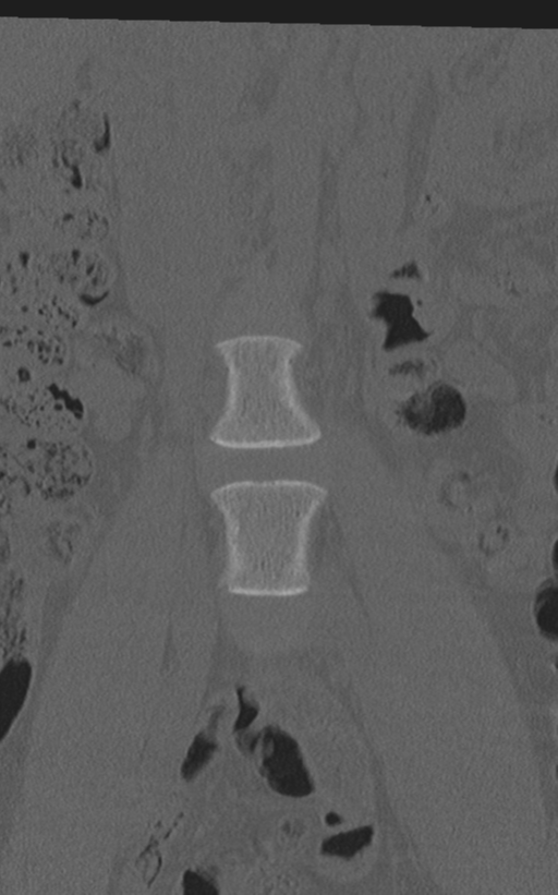 Normal lumbar spine CT (Radiopaedia 46533-50986 Coronal bone window 14).png