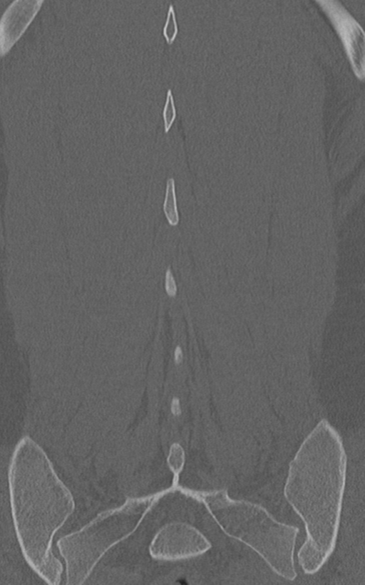 Normal lumbar spine CT (Radiopaedia 46533-50986 Coronal bone window 67).png