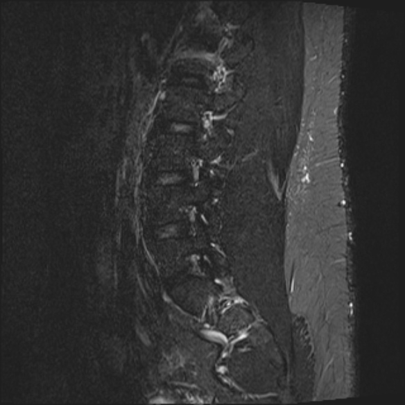 File:Normal lumbar spine MRI (Radiopaedia 47857-52609 Sagittal STIR 16).jpg