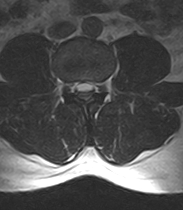 Normal lumbar spine MRI - low-field MRI scanner (Radiopaedia 40976-43699 Axial T2 57).jpg