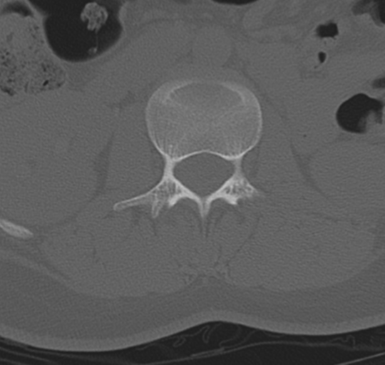 File:Normal lumbosacral CT (Radiopaedia 37923-39867 Axial bone window 42).png