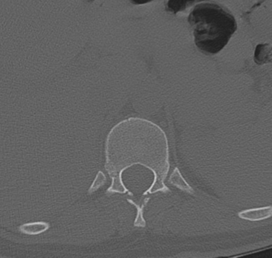 File:Normal lumbosacral CT (Radiopaedia 37923-39867 Axial bone window 9).png