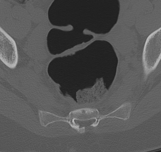 File:Normal lumbosacral CT (Radiopaedia 37923-39867 Axial bone window 99).png