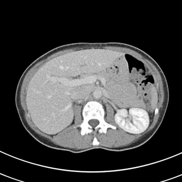 File:Normal multiphase CT liver (Radiopaedia 38026-39996 C 26).jpg