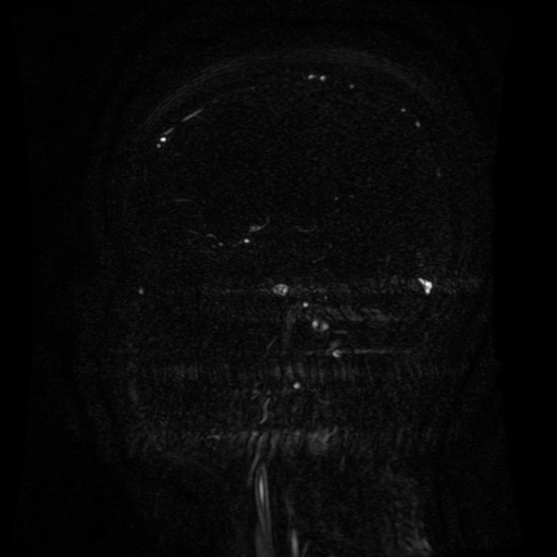 Normal noncontrast MR venography (Radiopaedia 87578-103957 A 113).jpg