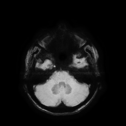 Normal noncontrast MR venography (Radiopaedia 87578-103957 Axial SWI 59).jpg