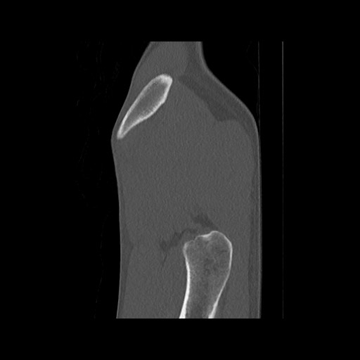 Normal pelvis (Radiopaedia 51473-57238 Sagittal bone window 13).jpg