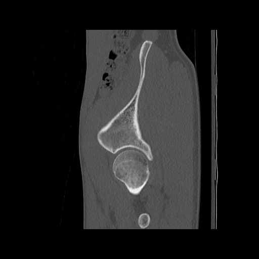 Normal pelvis (Radiopaedia 51473-57238 Sagittal bone window 30).jpg