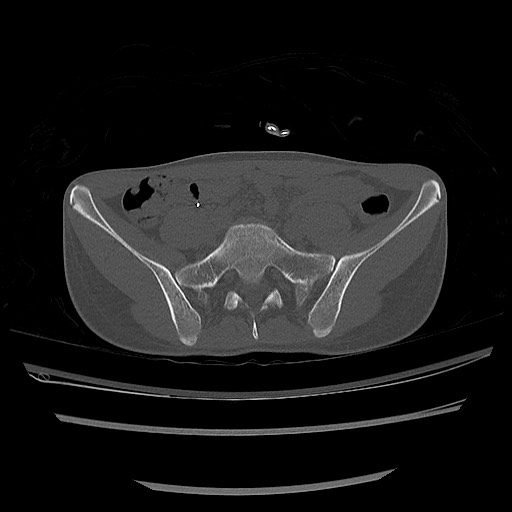 Normal pelvis CT (Radiopaedia 51471-57236 Axial bone window 25).jpg