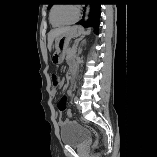 File:Obstructed kidney with perinephric urinoma (Radiopaedia 26889-27066 B 40).jpg