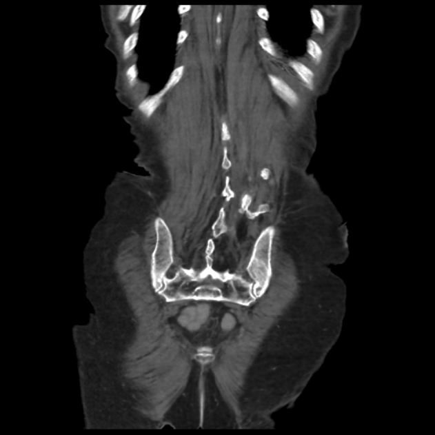 Obstructed obturator hernia (Radiopaedia 75197-86293 B 62).jpg