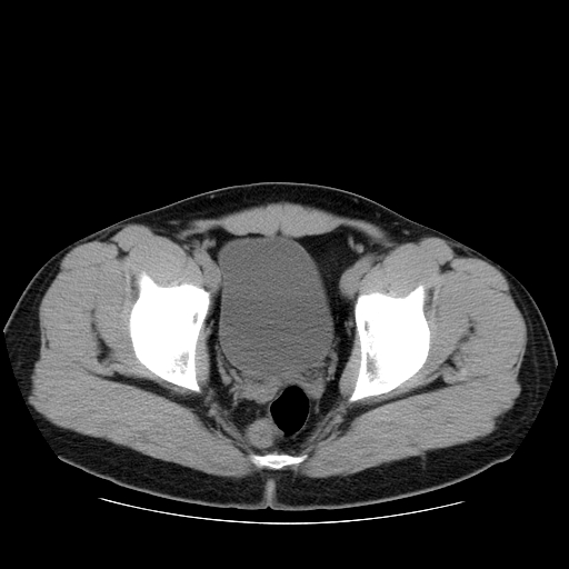 File:Obstructing ureteric calculus (Radiopaedia 18615-18514 Axial non-contrast 51).jpg