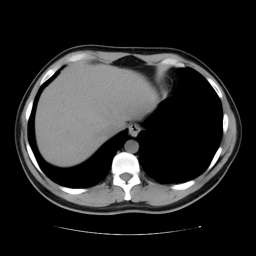 File:Obstructing ureteric calculus (Radiopaedia 18615-18514 Axial non-contrast 9).jpg