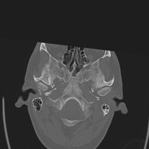 File:Obstructive hydrocephalus (Radiopaedia 30453-31119 Axial bone window 28).jpg