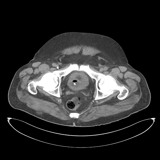 File:Obstructive pyelonephritis (Radiopaedia 46411-50844 Axial non-contrast 74).png