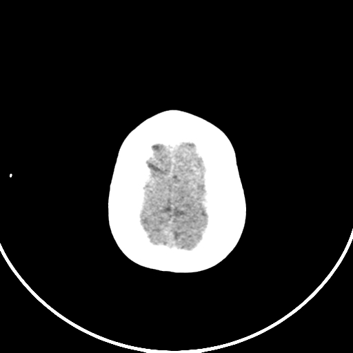 Occipital encephalocele (Radiopaedia 87339-103636 Axial non-contrast 74).jpg