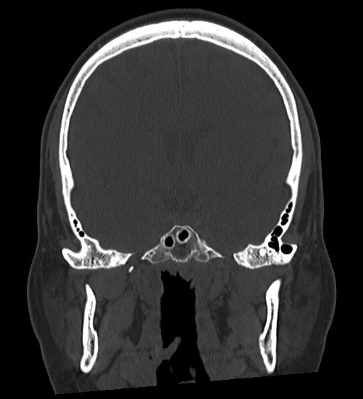 Occipital spur and Currarino type A atlas anomaly (Radiopaedia 87027-103285 Coronal bone window 74).jpg