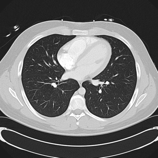 'Bovine' aortic arch (Radiopaedia 33554-34637 Axial lung window 36).png
