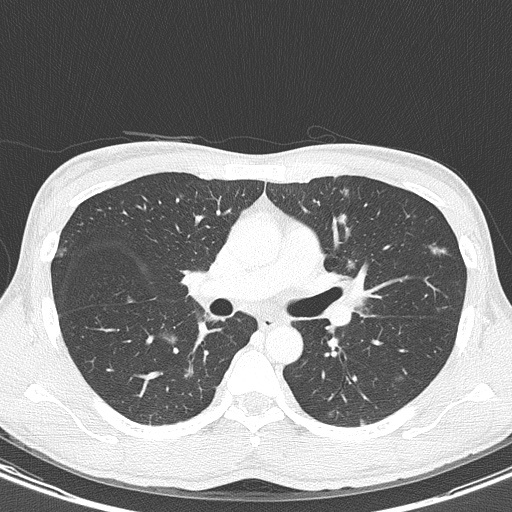 AIDS-related Kaposi sarcoma (Radiopaedia 85247-100811 Axial lung window 73).jpg