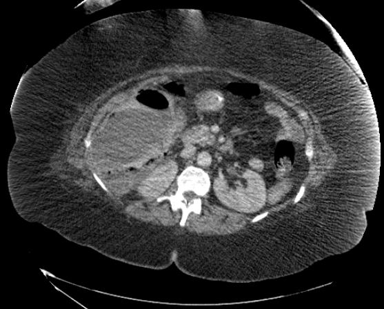 File:Abdominal abscess - pre and post percutaneous drainage (Radiopaedia 60209-67816 Axial 33).png