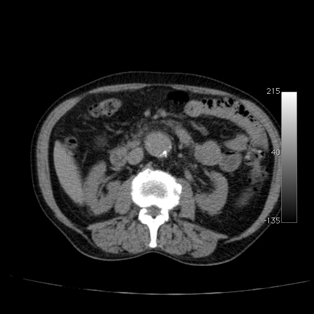 Abdominal aortic aneurysm (Radiopaedia 29248-29660 Axial non-contrast 25).jpg