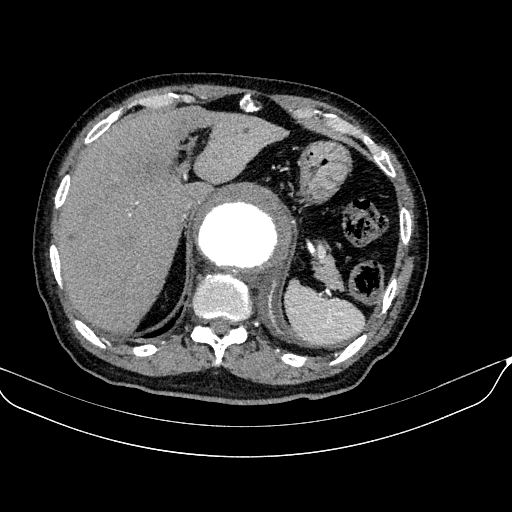 Abdominal aortic aneurysm (Radiopaedia 67117-76452 Axial C+ arterial phase 29).jpg