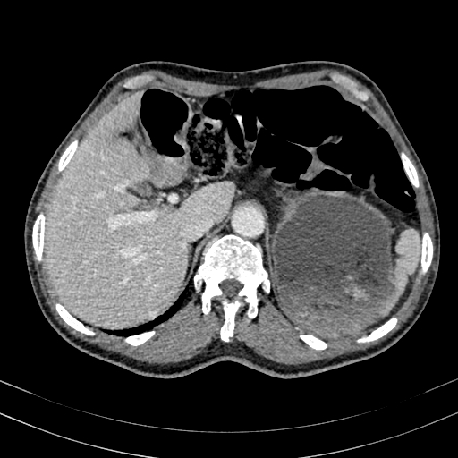 File:Abdominal aortic aneurysm (Radiopaedia 83581-98689 Axial C+ portal venous phase 25).jpg