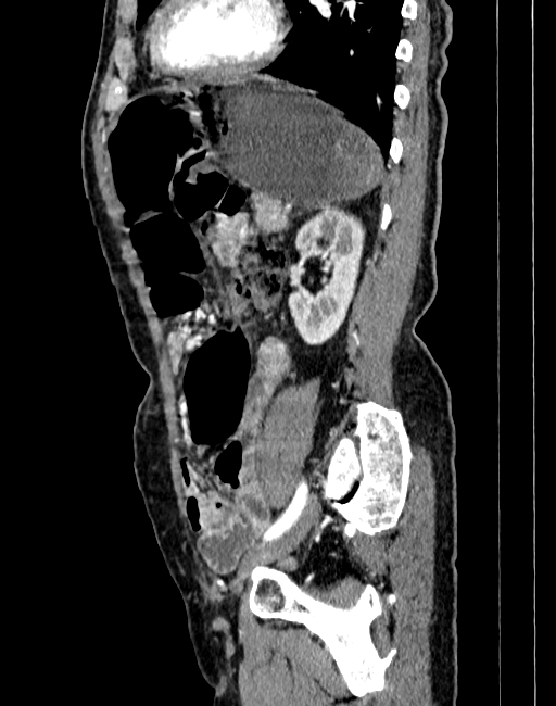 Abdominal aortic aneurysm (Radiopaedia 83581-98689 Sagittal C+ arterial phase 82).jpg