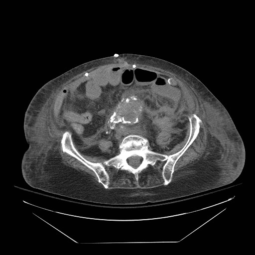 Abdominal aortic aneurysm - impending rupture (Radiopaedia 19233-19247 Axial non-contrast 115).jpg