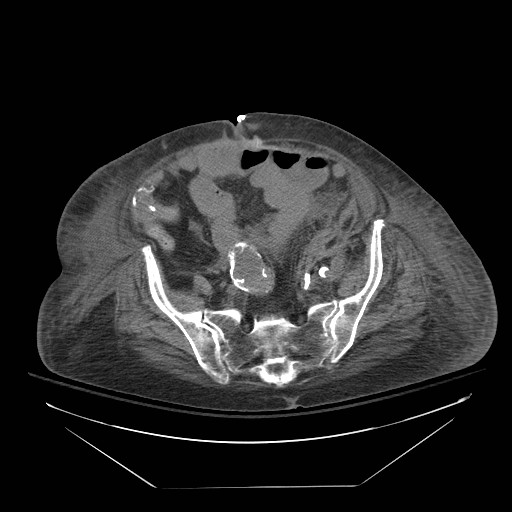 Abdominal aortic aneurysm - impending rupture (Radiopaedia 19233-19247 Axial non-contrast 126).jpg