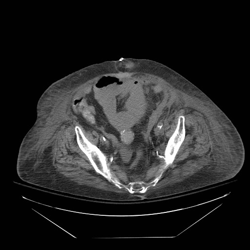 Abdominal aortic aneurysm - impending rupture (Radiopaedia 19233-19247 Axial non-contrast 135).jpg