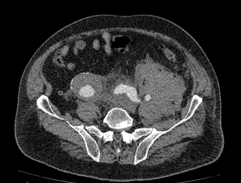 Abdominal aortic aneurysm rupture (Radiopaedia 54179-60362 Axial C+ arterial phase 43).jpg