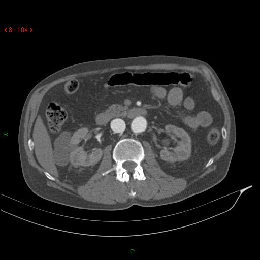 Abdominal aortic aneurysm rupture with aortocaval fistula (Radiopaedia 14897-14841 Axial C+ arterial phase 104).jpg