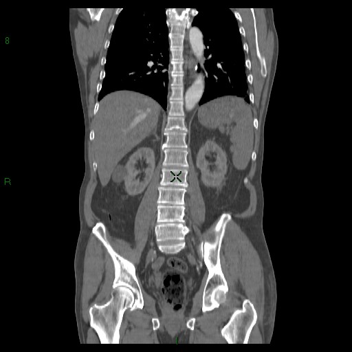File:Abdominal aortic aneurysm rupture with aortocaval fistula (Radiopaedia 14897-14841 Coronal C+ arterial phase 30).jpg