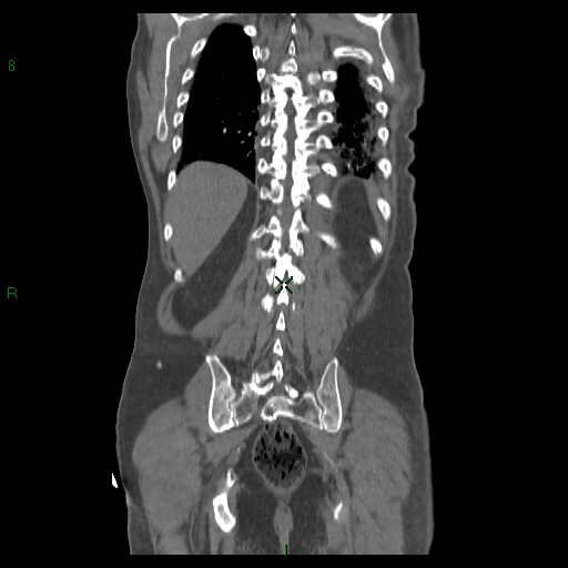 File:Abdominal aortic aneurysm rupture with aortocaval fistula (Radiopaedia 14897-14841 Coronal C+ arterial phase 35).jpg