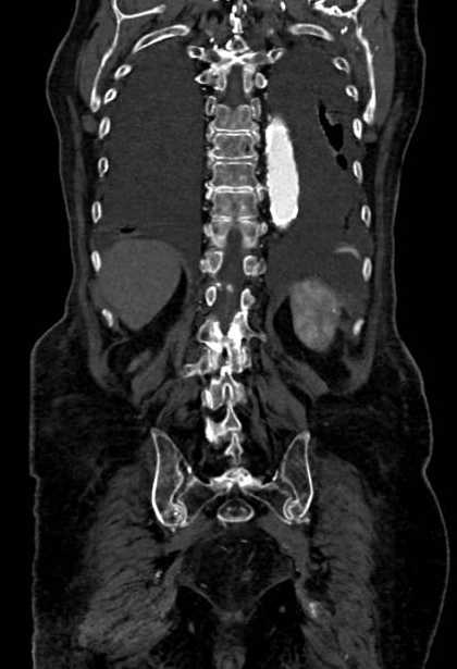 Abdominal aortic aneurysm with thrombus fissuration (Radiopaedia 73192-83919 Coronal C+ arterial phase 74).jpg