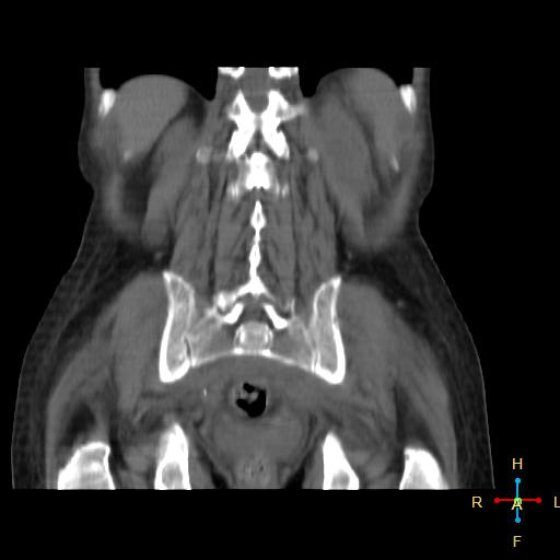 File:Abdominal lymphoma (Radiopaedia 23085-23115 Coronal non-contrast 1).jpg