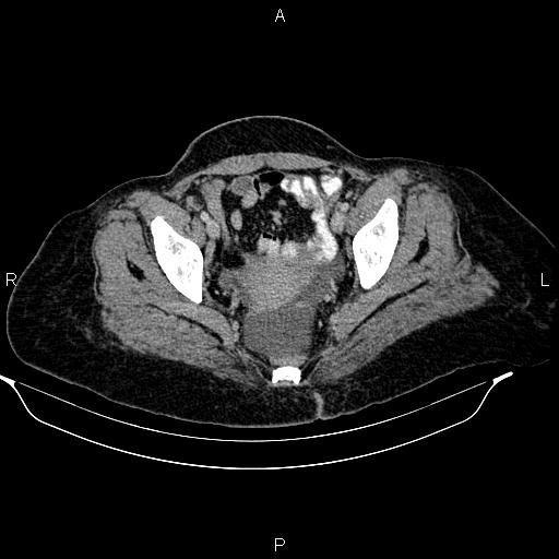 Abdominal lymphoma with sandwich sign (Radiopaedia 84378-99704 Axial C+ portal venous phase 51).jpg