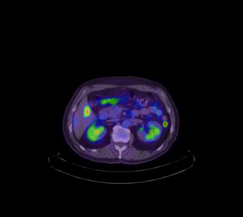 Abdominal wall metastasis from colorectal carcinoma (Radiopaedia 31016-31719 Axial 73).jpg