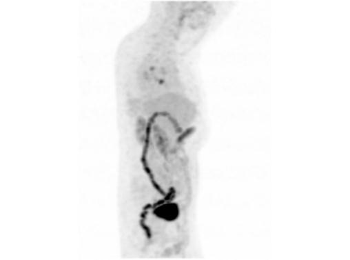 File:Abdominal wall metastasis from colorectal carcinoma (Radiopaedia 31016-31719 Rotational MIP 22).jpg