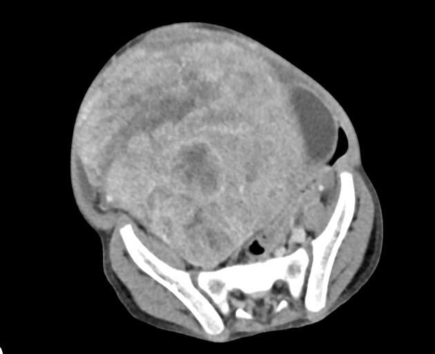 Abdominopelvic rhabdomyosarcoma (Radiopaedia 78356-90984 Axial C+ portal venous phase 127).jpg