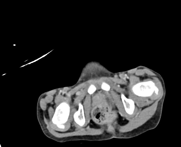 File:Abdominopelvic rhabdomyosarcoma (Radiopaedia 78356-90984 Axial C+ portal venous phase 154).jpg