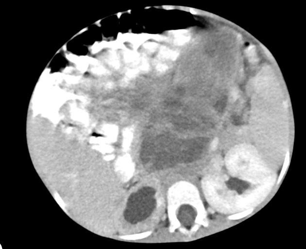Abdominopelvic rhabdomyosarcoma (Radiopaedia 78356-90984 Axial C+ portal venous phase 72).jpg