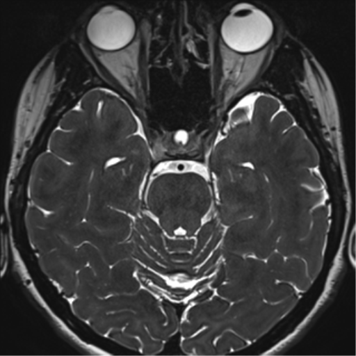 Abducens nerve palsy (Radiopaedia 51069-56648 Axial T2 fat sat 52).png