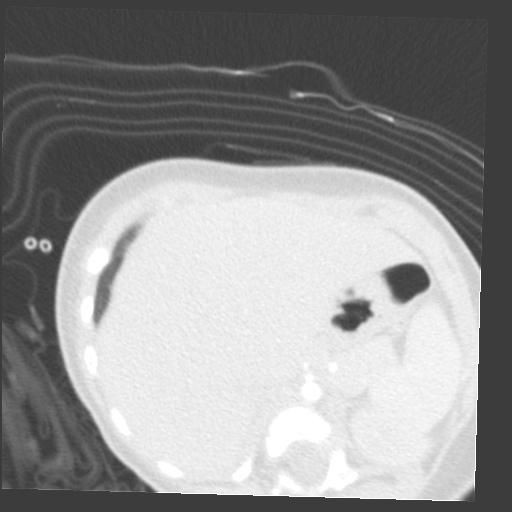 File:Aberrant left pulmonary artery (pulmonary sling) (Radiopaedia 42323-45435 Axial lung window 42).jpg