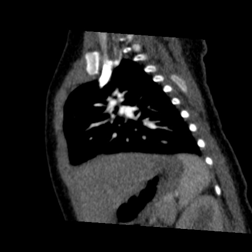 File:Aberrant left pulmonary artery (pulmonary sling) (Radiopaedia 42323-45435 Sagittal C+ arterial phase 38).jpg
