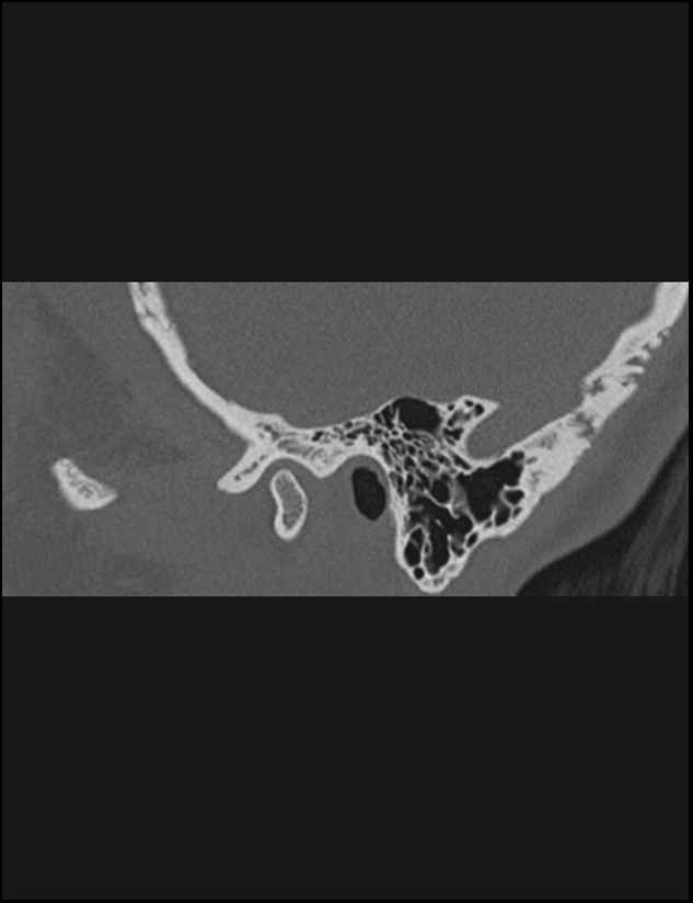 Aberrant right internal carotid artery (Radiopaedia 65191-74198 Sagittal non-contrast 25).jpg