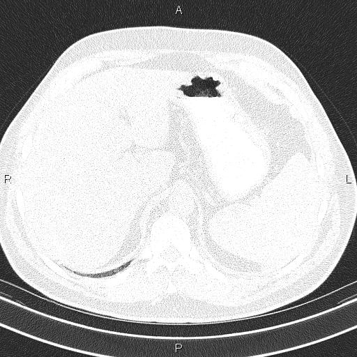 Aberrant right subclavian artery (Radiopaedia 87093-103354 Axial lung window 110).jpg